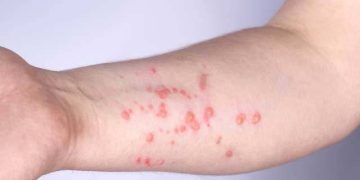 How to avoid monkeypox