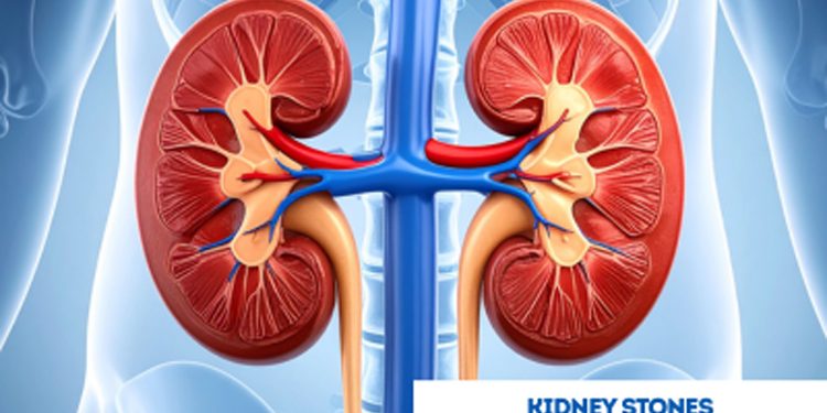 How to protect yourself from kidney stones