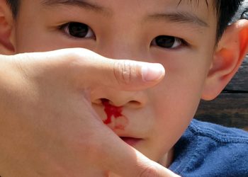 Nosebleeds in summer, normal or a silent sign of death