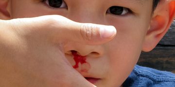 Nosebleeds in summer, normal or a silent sign of death