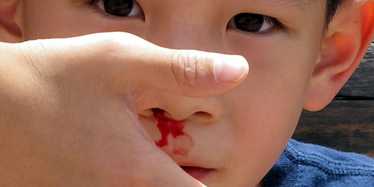 Nosebleeds in summer, normal or a silent sign of death