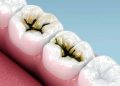 Simple method discovered to stop tooth decay without drilling.