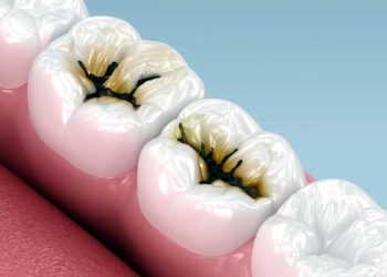 Simple method discovered to stop tooth decay without drilling.