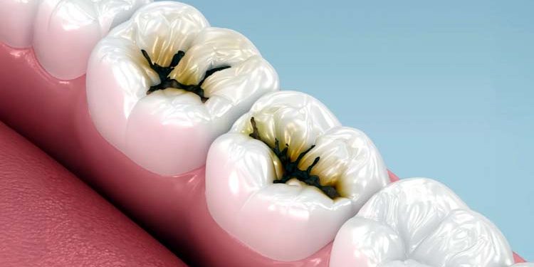Simple method discovered to stop tooth decay without drilling.