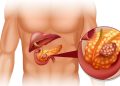 Significant progress in the treatment of pancreatic cancer