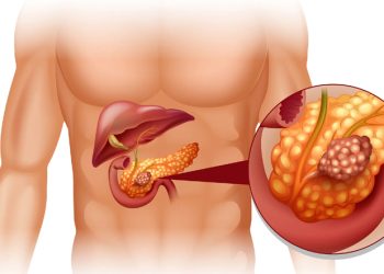 Significant progress in the treatment of pancreatic cancer