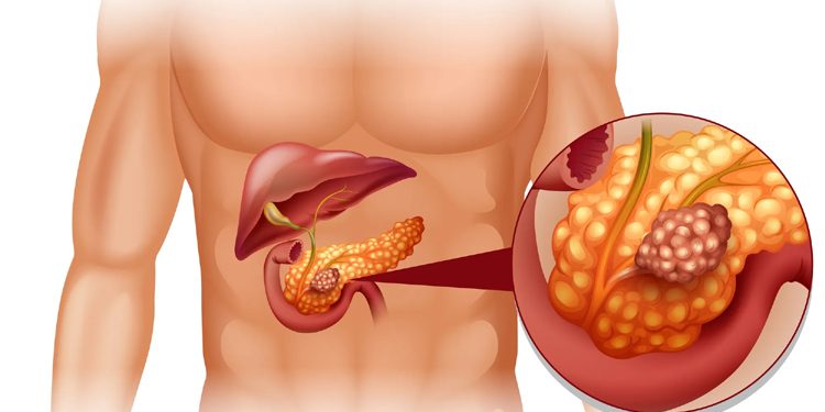 Significant progress in the treatment of pancreatic cancer