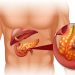 Significant progress in the treatment of pancreatic cancer